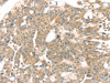 The image on the left is immunohistochemistry of paraffin-embedded Human breast cancer tissue using CSB-PA778095 (TPST1 Antibody) at dilution 1/20, on the right is treated with synthetic peptide. (Original magnification: ×200)