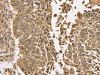 The image on the left is immunohistochemistry of paraffin-embedded Human lung cancer tissue using CSB-PA577486 (TGM6 Antibody) at dilution 1/35, on the right is treated with synthetic peptide. (Original magnification: ×200)
