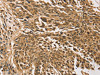 The image on the left is immunohistochemistry of paraffin-embedded Human lung cancer tissue using CSB-PA793720 (TGM7 Antibody) at dilution 1/30, on the right is treated with synthetic peptide. (Original magnification: ×200)