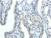 The image on the left is immunohistochemistry of paraffin-embedded Human thyroid cancer tissue using CSB-PA288894 (TRIB1 Antibody) at dilution 1/20, on the right is treated with synthetic peptide. (Original magnification: ×200)