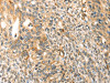 The image on the left is immunohistochemistry of paraffin-embedded Human breast cancer tissue using CSB-PA156794 (TRPV3 Antibody) at dilution 1/30, on the right is treated with synthetic peptide. (Original magnification: ×200)