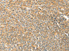 The image on the left is immunohistochemistry of paraffin-embedded Human ovarian cancer tissue using CSB-PA688265 (TRPV3 Antibody) at dilution 1/25, on the right is treated with synthetic peptide. (Original magnification: ×200)