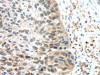 The image on the left is immunohistochemistry of paraffin-embedded Human esophagus cancer tissue using CSB-PA696394 (TSPY1/TSPY3 Antibody) at dilution 1/45, on the right is treated with synthetic peptide. (Original magnification: ×200)
