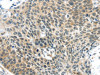 The image on the left is immunohistochemistry of paraffin-embedded Human esophagus cancer tissue using CSB-PA078085 (TSPY1 Antibody) at dilution 1/40, on the right is treated with synthetic peptide. (Original magnification: ×200)