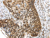 The image on the left is immunohistochemistry of paraffin-embedded Human esophagus cancer tissue using CSB-PA657723 (TEX37 Antibody) at dilution 1/40, on the right is treated with synthetic peptide. (Original magnification: ×200)