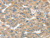 The image on the left is immunohistochemistry of paraffin-embedded Human liver cancer tissue using CSB-PA290881 (TUSC1 Antibody) at dilution 1/45, on the right is treated with synthetic peptide. (Original magnification: ×200)
