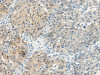 The image on the left is immunohistochemistry of paraffin-embedded Human breast cancer tissue using CSB-PA449379 (TBXA2R Antibody) at dilution 1/45, on the right is treated with synthetic peptide. (Original magnification: ×200)