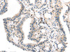 The image on the left is immunohistochemistry of paraffin-embedded Human thyroid cancer tissue using CSB-PA550037 (TBXA2R Antibody) at dilution 1/40, on the right is treated with synthetic peptide. (Original magnification: ×200)