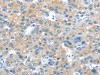 The image on the left is immunohistochemistry of paraffin-embedded Human liver cancer tissue using CSB-PA438768 (ERP44 Antibody) at dilution 1/20, on the right is treated with synthetic peptide. (Original magnification: ×200)