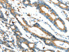 The image on the left is immunohistochemistry of paraffin-embedded Human colorectal cancer tissue using CSB-PA438768 (ERP44 Antibody) at dilution 1/20, on the right is treated with synthetic peptide. (Original magnification: ×200)