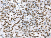 The image on the left is immunohistochemistry of paraffin-embedded Human breast cancer tissue using CSB-PA279529 (DDX39B Antibody) at dilution 1/35, on the right is treated with synthetic peptide. (Original magnification: ×200)