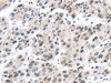 The image on the left is immunohistochemistry of paraffin-embedded Human liver cancer tissue using CSB-PA279529 (DDX39B Antibody) at dilution 1/35, on the right is treated with synthetic peptide. (Original magnification: ×200)