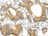 The image on the left is immunohistochemistry of paraffin-embedded Human colorectal cancer tissue using CSB-PA056268 (UBTD1 Antibody) at dilution 1/30, on the right is treated with synthetic peptide. (Original magnification: ×200)