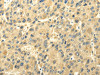 The image on the left is immunohistochemistry of paraffin-embedded Human liver cancer tissue using CSB-PA056617 (UGT1A6 Antibody) at dilution 1/35, on the right is treated with synthetic peptide. (Original magnification: ×200)