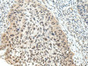 The image on the left is immunohistochemistry of paraffin-embedded Human esophagus cancer tissue using CSB-PA144842 (NSD1 Antibody) at dilution 1/25, on the right is treated with synthetic peptide. (Original magnification: ×200)
