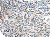 The image on the left is immunohistochemistry of paraffin-embedded Human esophagus cancer tissue using CSB-PA829622 (USP7 Antibody) at dilution 1/30, on the right is treated with synthetic peptide. (Original magnification: ×200)