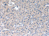 The image on the left is immunohistochemistry of paraffin-embedded Human liver cancer tissue using CSB-PA287240 (RAB2A Antibody) at dilution 1/40, on the right is treated with synthetic peptide. (Original magnification: ×200)