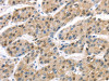 The image on the left is immunohistochemistry of paraffin-embedded Human liver cancer tissue using CSB-PA251266 (TAB1 Antibody) at dilution 1/30, on the right is treated with synthetic peptide. (Original magnification: ×200)