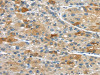 The image on the left is immunohistochemistry of paraffin-embedded Human liver cancer tissue using CSB-PA084938 (UPP2 Antibody) at dilution 1/35, on the right is treated with synthetic peptide. (Original magnification: ×200)