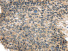 The image on the left is immunohistochemistry of paraffin-embedded Human esophagus cancer tissue using CSB-PA120935 (USP9X Antibody) at dilution 1/35, on the right is treated with synthetic peptide. (Original magnification: ×200)