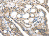 The image on the left is immunohistochemistry of paraffin-embedded Human thyroid cancer tissue using CSB-PA120935 (USP9X Antibody) at dilution 1/35, on the right is treated with synthetic peptide. (Original magnification: ×200)