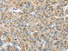 The image on the left is immunohistochemistry of paraffin-embedded Human liver cancer tissue using CSB-PA794181 (USP9X Antibody) at dilution 1/40, on the right is treated with synthetic peptide. (Original magnification: ×200)