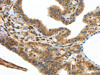 The image on the left is immunohistochemistry of paraffin-embedded Human thyroid cancer tissue using CSB-PA062674 (UTS2B Antibody) at dilution 1/25, on the right is treated with synthetic peptide. (Original magnification: ×200)