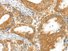 The image on the left is immunohistochemistry of paraffin-embedded Human esophagus cancer tissue using CSB-PA955390 (MPP6 Antibody) at dilution 1/40, on the right is treated with synthetic peptide. (Original magnification: ×200)