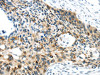 The image on the left is immunohistochemistry of paraffin-embedded Human esophagus cancer tissue using CSB-PA273818 (VAMP2 Antibody) at dilution 1/40, on the right is treated with synthetic peptide. (Original magnification: ×200)