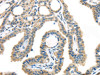 The image on the left is immunohistochemistry of paraffin-embedded Human thyroid cancer tissue using CSB-PA051160 (VGF Antibody) at dilution 1/45, on the right is treated with synthetic peptide. (Original magnification: ×200)