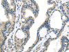 The image on the left is immunohistochemistry of paraffin-embedded Human thyroid cancer tissue using CSB-PA980886 (VGF Antibody) at dilution 1/35, on the right is treated with synthetic peptide. (Original magnification: ×200)