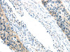 The image on the left is immunohistochemistry of paraffin-embedded Human esophagus cancer tissue using CSB-PA980886 (VGF Antibody) at dilution 1/35, on the right is treated with synthetic peptide. (Original magnification: ×200)