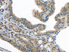 The image on the left is immunohistochemistry of paraffin-embedded Human thyroid cancer tissue using CSB-PA830584 (VLDLR Antibody) at dilution 1/40, on the right is treated with synthetic peptide. (Original magnification: ×200)