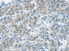 The image on the left is immunohistochemistry of paraffin-embedded Human liver cancer tissue using CSB-PA279988 (VLDLR Antibody) at dilution 1/35, on the right is treated with synthetic peptide. (Original magnification: ×200)