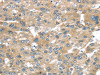 The image on the left is immunohistochemistry of paraffin-embedded Human liver cancer tissue using CSB-PA175261 (BRWD1 Antibody) at dilution 1/25, on the right is treated with synthetic peptide. (Original magnification: ×200)