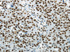 The image on the left is immunohistochemistry of paraffin-embedded Human breast cancer tissue using CSB-PA032302 (HNRNPM Antibody) at dilution 1/25, on the right is treated with synthetic peptide. (Original magnification: ×200)