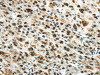 The image on the left is immunohistochemistry of paraffin-embedded Human liver cancer tissue using CSB-PA032302 (HNRNPM Antibody) at dilution 1/25, on the right is treated with synthetic peptide. (Original magnification: ×200)