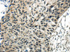 The image on the left is immunohistochemistry of paraffin-embedded Human esophagus cancer tissue using CSB-PA124592 (SYNCRIP Antibody) at dilution 1/30, on the right is treated with synthetic peptide. (Original magnification: ×200)