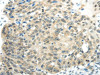 The image on the left is immunohistochemistry of paraffin-embedded Human breast cancer tissue using CSB-PA124592 (SYNCRIP Antibody) at dilution 1/30, on the right is treated with synthetic peptide. (Original magnification: ×200)