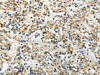 The image on the left is immunohistochemistry of paraffin-embedded Human prostate cancer tissue using CSB-PA443873 (WNK3 Antibody) at dilution 1/20, on the right is treated with synthetic peptide. (Original magnification: ×200) The image on the left is immunohistochemistry of paraffin-embedded Human prostate cancer tissue using CSB-PA443873 (WNK3 Antibody) at dilution 1/20, on the right is treated with synthetic peptide. (Original magnification: ×200)