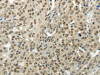 The image on the left is immunohistochemistry of paraffin-embedded Human breast cancer tissue using CSB-PA591538 (BAZ1B Antibody) at dilution 1/35, on the right is treated with synthetic peptide. (Original magnification: ×200)