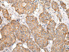 The image on the left is immunohistochemistry of paraffin-embedded Human breast cancer tissue using CSB-PA295305 (COL8A2 Antibody) at dilution 1/20, on the right is treated with synthetic peptide. (Original magnification: ×200)