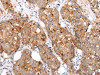 The image on the left is immunohistochemistry of paraffin-embedded Human breast cancer tissue using CSB-PA583379 (MUC1 (CT) Antibody) at dilution 1/20, on the right is treated with synthetic peptide. (Original magnification: ×200)