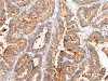 The image on the left is immunohistochemistry of paraffin-embedded Human esophagus cancer tissue using CSB-PA583379 (MUC1 (CT) Antibody) at dilution 1/20, on the right is treated with synthetic peptide. (Original magnification: ×200)