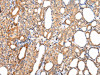 The image on the left is immunohistochemistry of paraffin-embedded Human thyroid cancer tissue using CSB-PA276755 (AQP7 Antibody) at dilution 1/40, on the right is treated with synthetic peptide. (Original magnification: ×200)