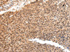 The image on the left is immunohistochemistry of paraffin-embedded Human lung cancer tissue using CSB-PA221484 (ATF1 Antibody) at dilution 1/35, on the right is treated with synthetic peptide. (Original magnification: ×200)