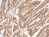The image on the left is immunohistochemistry of paraffin-embedded Human esophagus cancer tissue using CSB-PA253608 (ATP7B Antibody) at dilution 1/20, on the right is treated with synthetic peptide. (Original magnification: ×200)