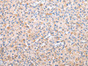 The image on the left is immunohistochemistry of paraffin-embedded Human liver cancer tissue using CSB-PA828936 (AXIN1 Antibody) at dilution 1/30, on the right is treated with synthetic peptide. (Original magnification: ×200)