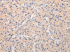 The image on the left is immunohistochemistry of paraffin-embedded Human liver cancer tissue using CSB-PA579827 (ABCC1 Antibody) at dilution 1/20, on the right is treated with synthetic peptide. (Original magnification: ×200)