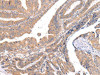 The image on the left is immunohistochemistry of paraffin-embedded Human esophagus cancer tissue using CSB-PA579827 (ABCC1 Antibody) at dilution 1/20, on the right is treated with synthetic peptide. (Original magnification: ×200)